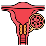 cervical cancer.png